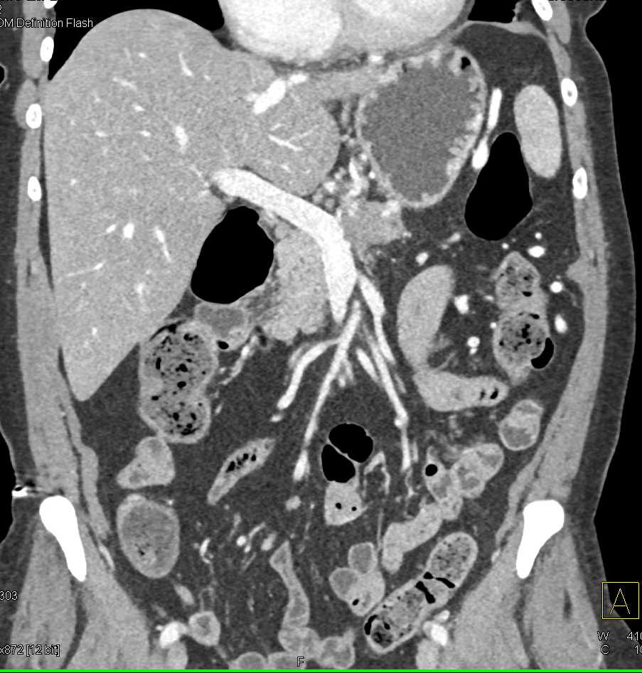 Pancreatic Adenocarcinoma Occludes the Splenic Vein - CTisus CT Scan