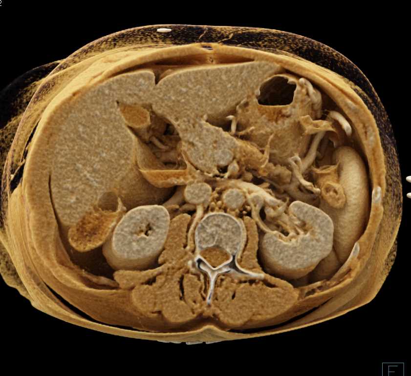 Carcinoma Body of the Pancreas with Cinematic Rendering - CTisus CT Scan