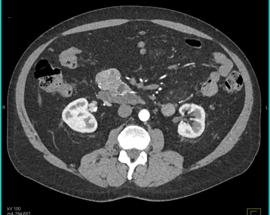 Serous Cystadenoma Head of Pancreas - CTisus CT Scan