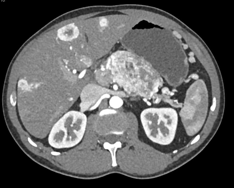 Neuroendocrine Tumor Pancreas with Liver Metastases - CTisus CT Scan