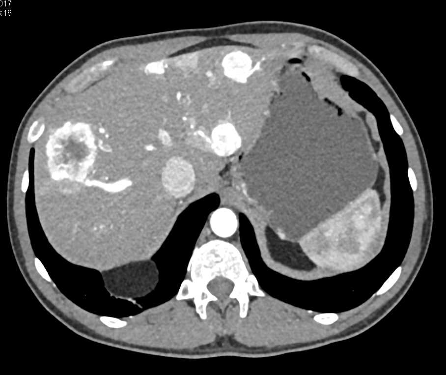 Neuroendocrine Tumor Pancreas With Liver Metastases Pancreas Case