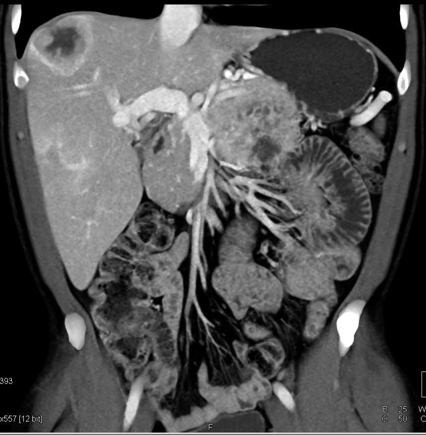 Pancreatic Neuroendocrine Tumor (PNET) Pancreas and Liver Metastases ...