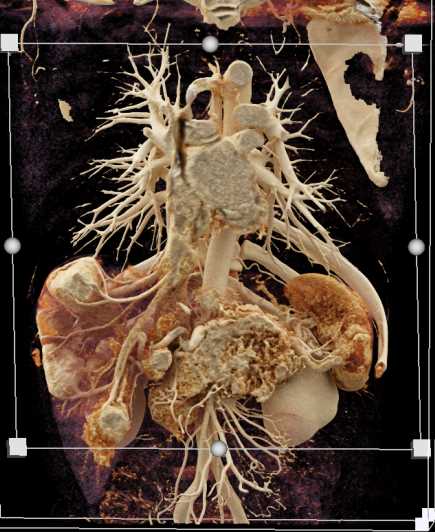 Pancreatic Neuroendocrine Tumor (PNET) Pancreas and Liver Metastases with Cinematic Rendering - CTisus CT Scan