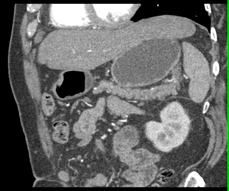 Subtle Carcinoma Tail of the Pancreas - CTisus CT Scan