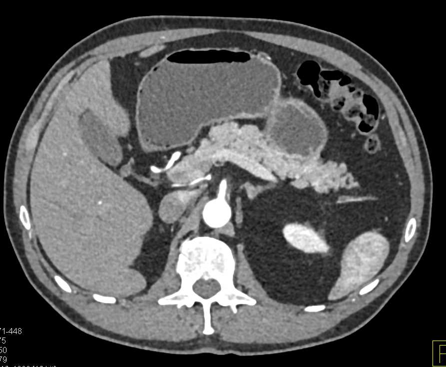 Renal Cell Carcinoma (RCC) with Right Nephrectomy and Tiny Vascular Lesions in the Pancreas (subtle) - CTisus CT Scan