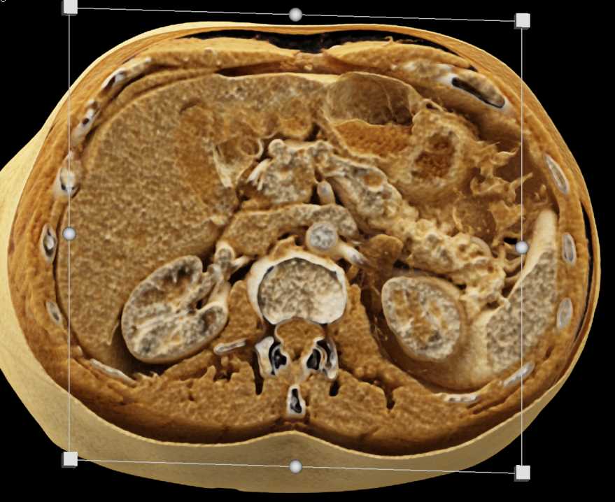 Cystic Pancreatic Neuroendocrine Tumor with Cinematic Rendering - CTisus CT Scan