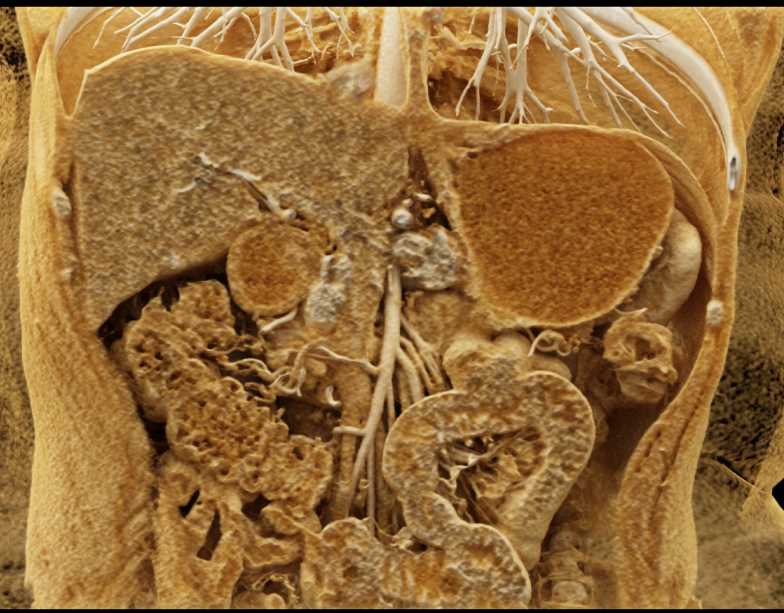 Pancreatic Cancer in the Body of the Pancreas with Cinematic Rendering - CTisus CT Scan