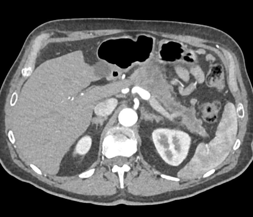 Pancreatic Adenocarcinoma - CTisus CT Scan