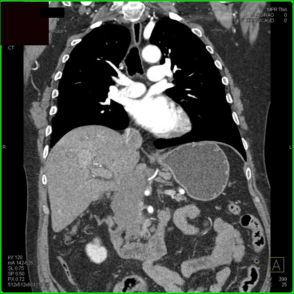 Lymphoma with Peripancreatic Adenopathy - CTisus CT Scan