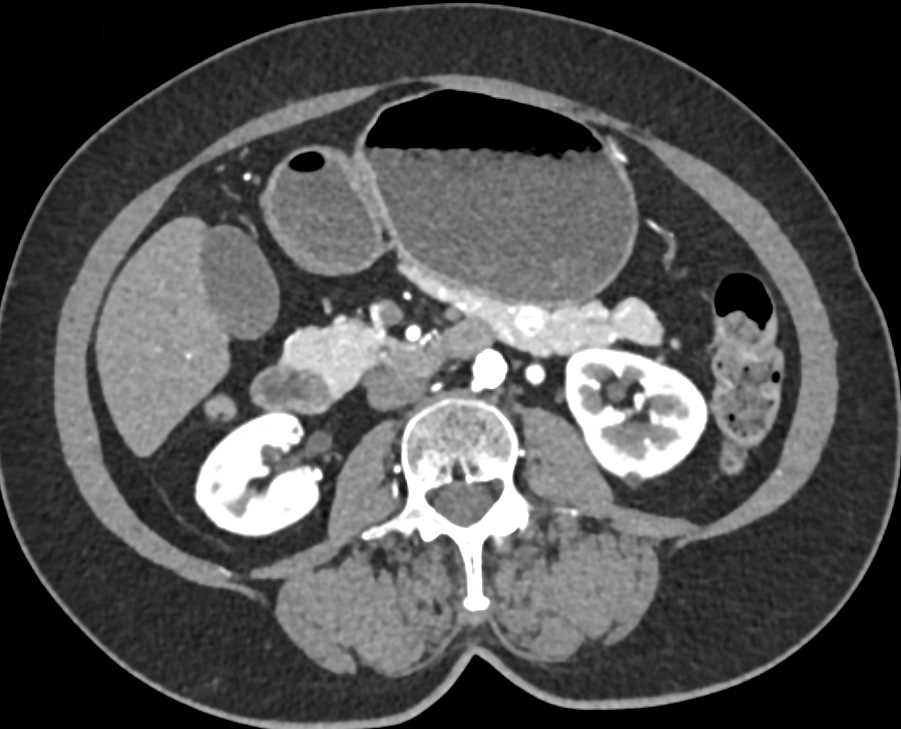 1cm Pancreatic Neuroendocrine Tumor (PNET) in the Body of the Pancreas - CTisus CT Scan