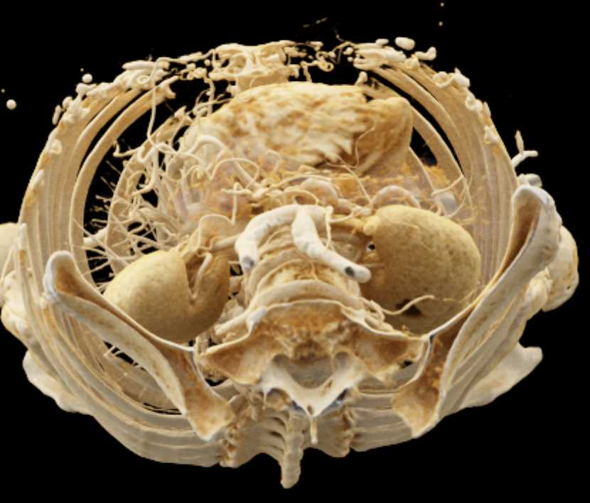 1cm Pancreatic Neuroendocrine Tumor (PNET) in the Body of the Pancreas with Cinematic Rendering - CTisus CT Scan