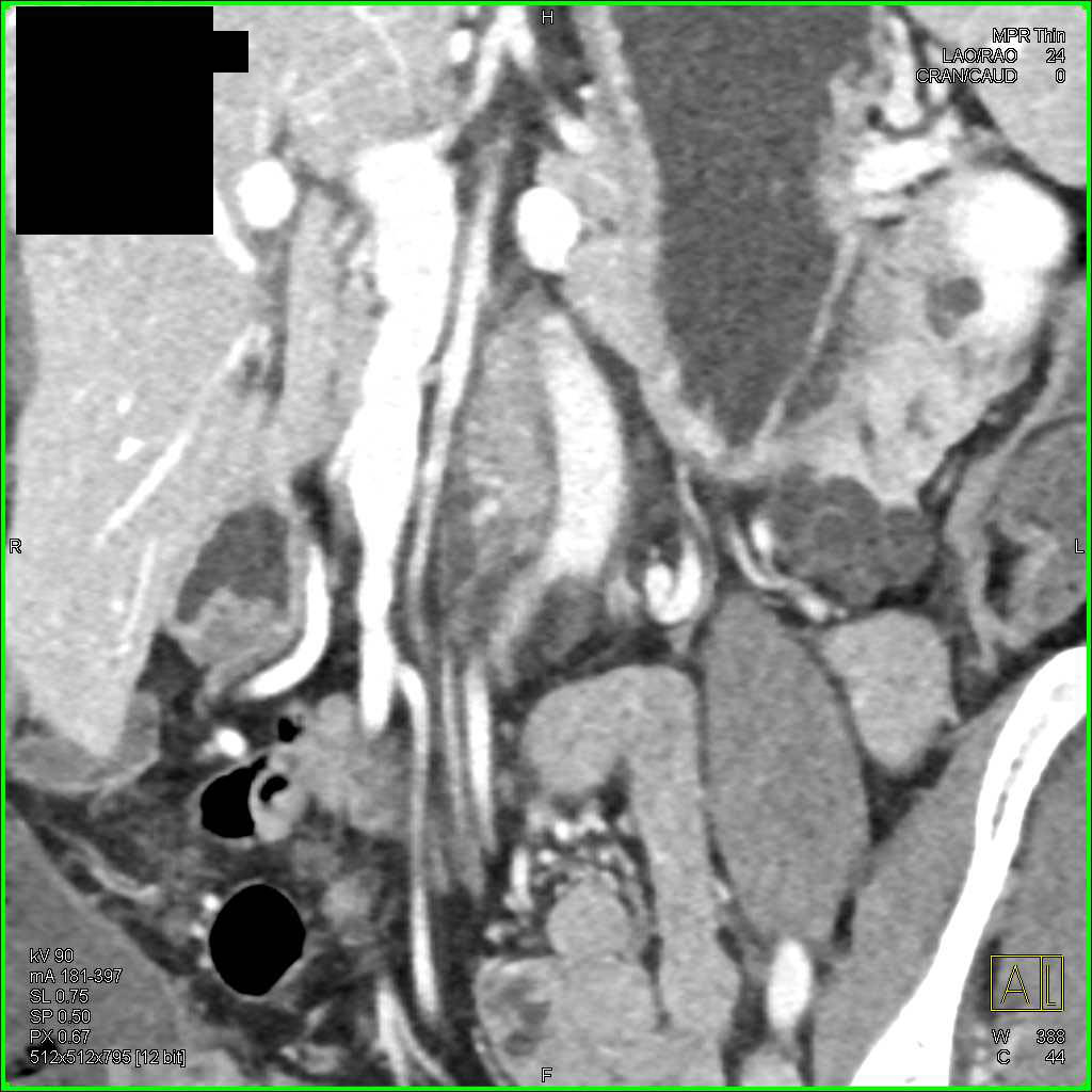 Intraductal Papillary Mucinous Neoplasm (IPMN) Tail of the Pancreas - CTisus CT Scan