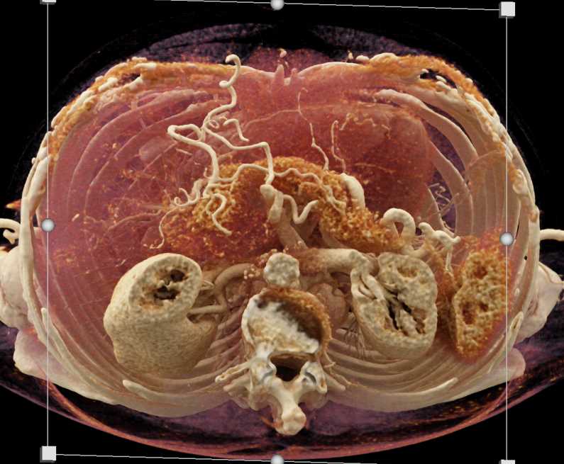 Adenocarcinoma Head of Pancreas with Vascular Invasion and Cinematic Rendering - CTisus CT Scan