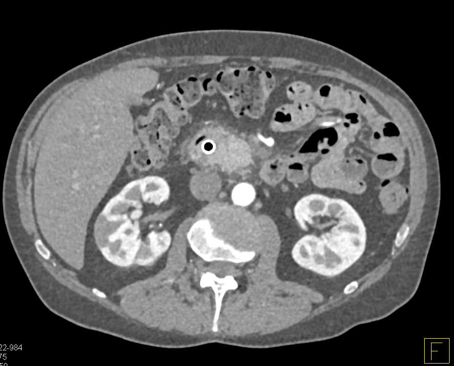 Autoimmune Pancreatitis Simulates a Pancreatic Cancer - CTisus CT Scan