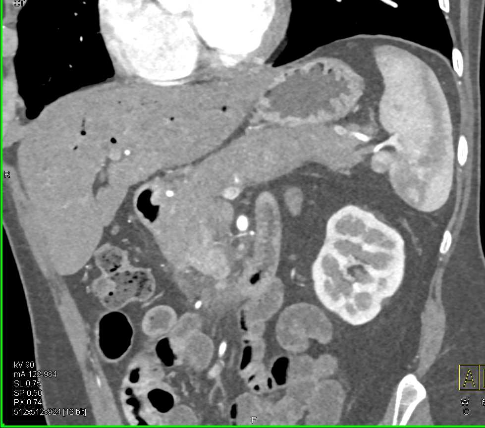 Autoimmune Pancreatitis Simulates A Pancreatic Cancer Pancreas Case