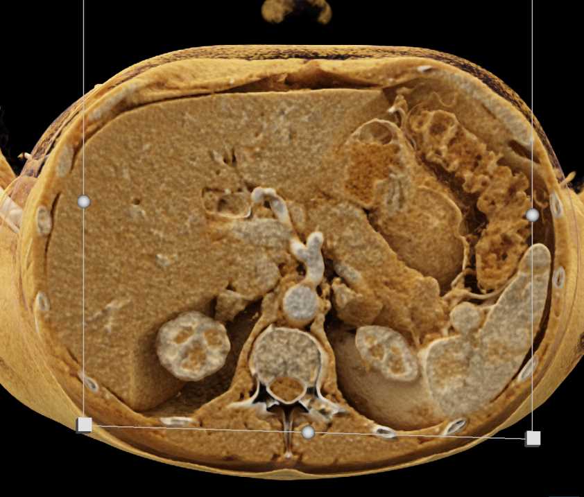 Autoimmune Pancreatitis Simulates a Pancreatic Cancer with Cinematic Rendering - CTisus CT Scan