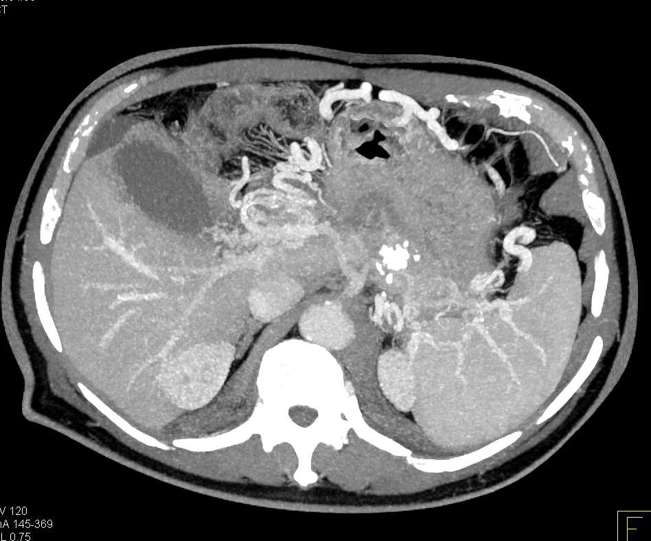 Invasive Pancreatic Cancer with Cavernous Transformation of the Portal Vein (CTPV) - CTisus CT Scan