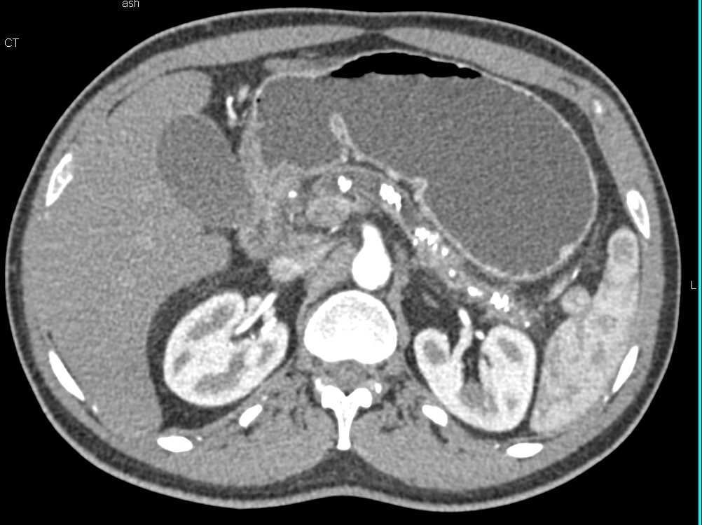 Chronic Pancreatitis - CTisus CT Scan