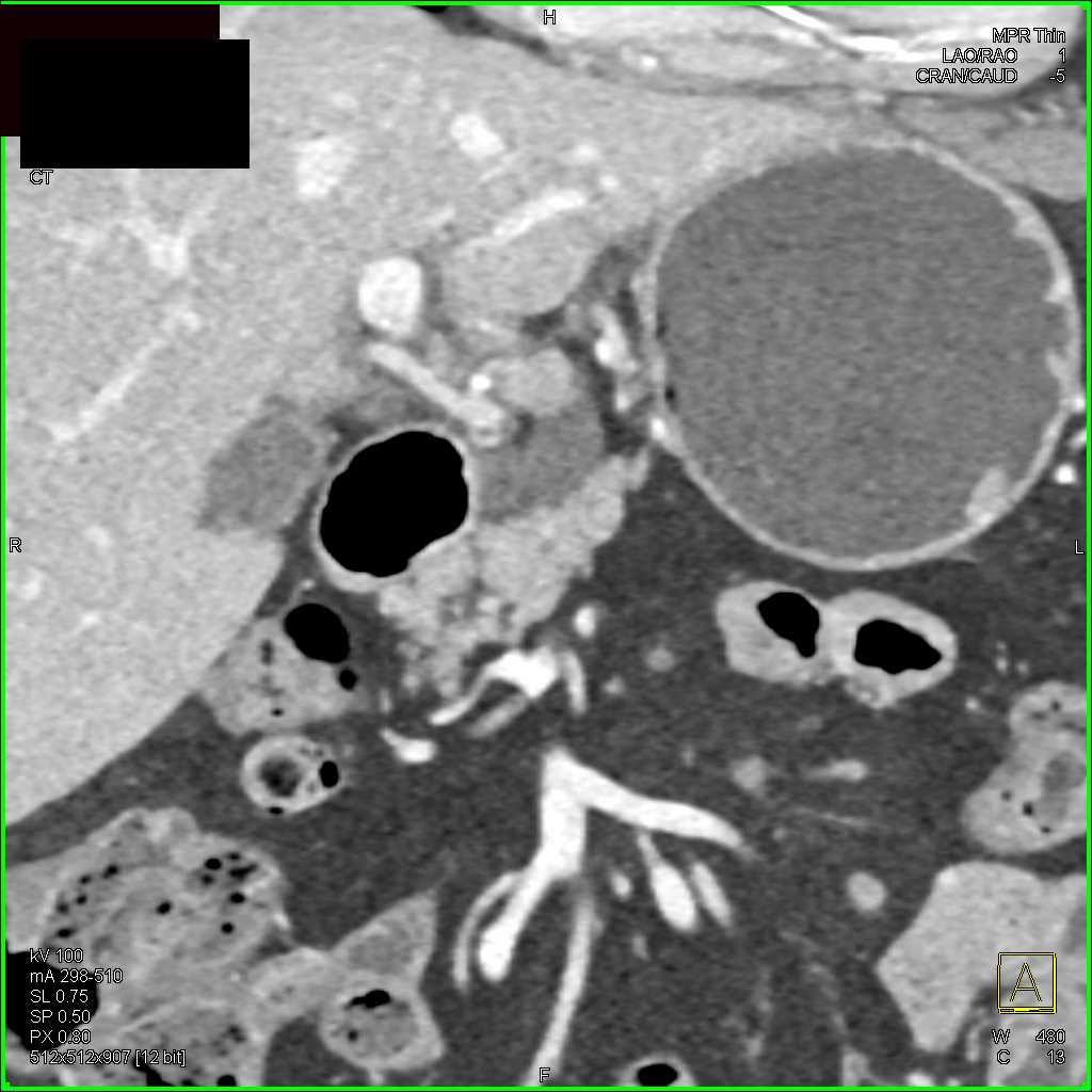 Intraductal Papillary Mucinous Neoplasm (IPMN) - CTisus CT Scan