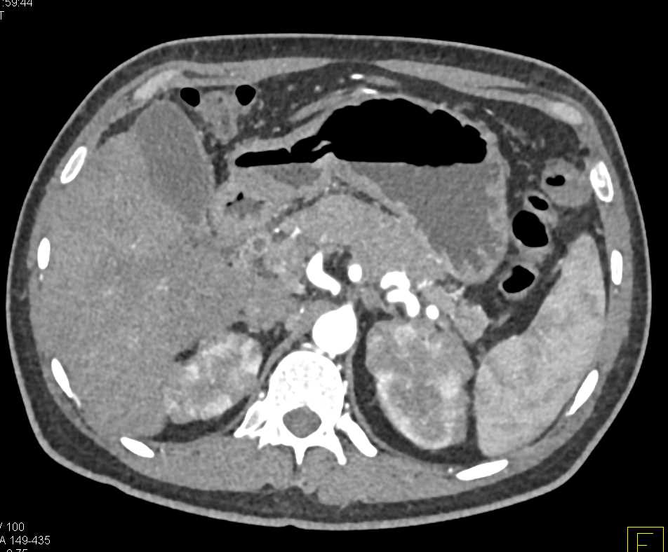 Autoimmune Pancreatitis with Renal Involvement - CTisus CT Scan