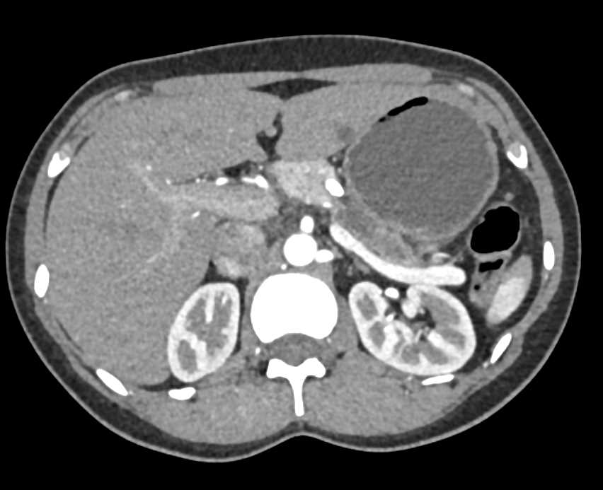 Carcinoma Body of the Pancreas - CTisus CT Scan