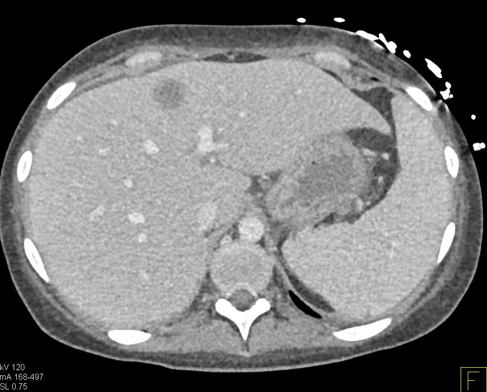 Pancreas Adenocarcinoma with Liver Metastases and Adenopathy - CTisus CT Scan