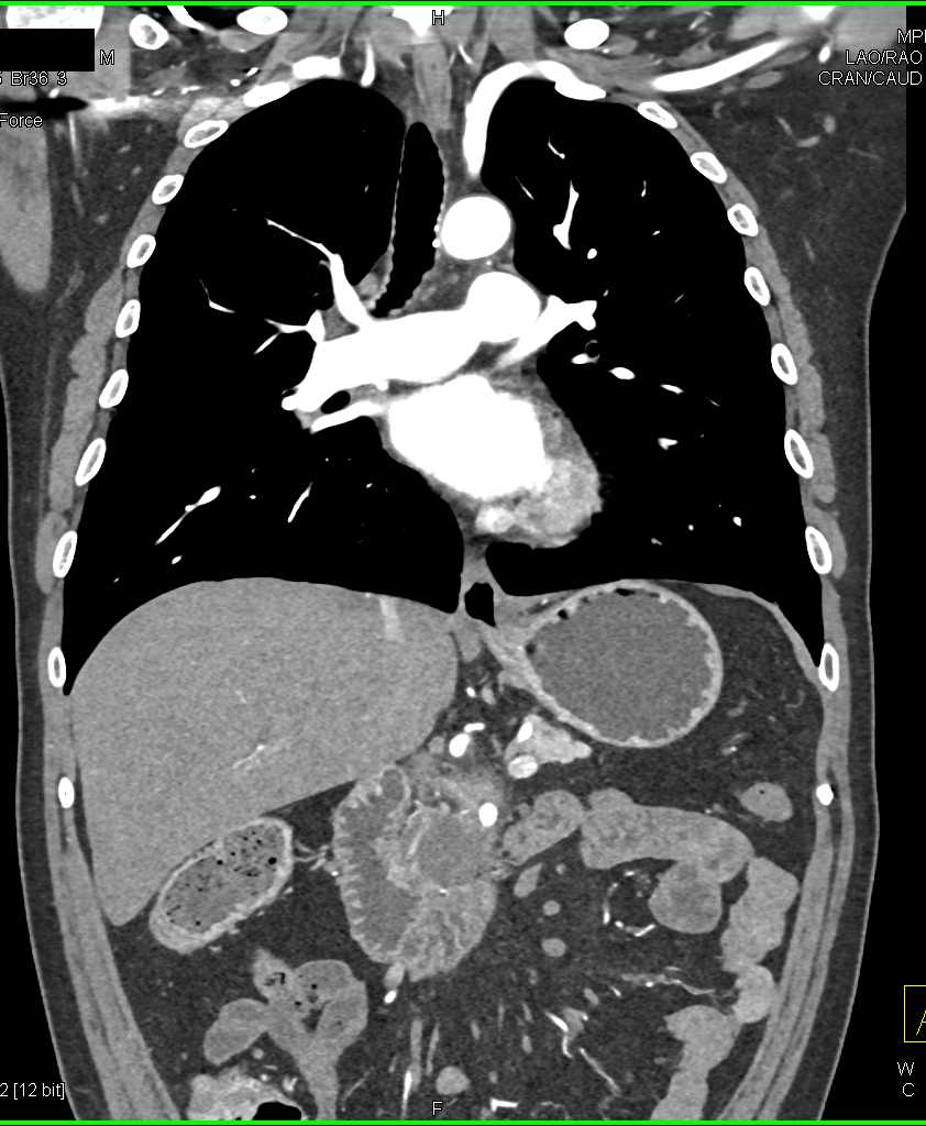 Pancreatic Cancer with Vascular Encasement - CTisus CT Scan