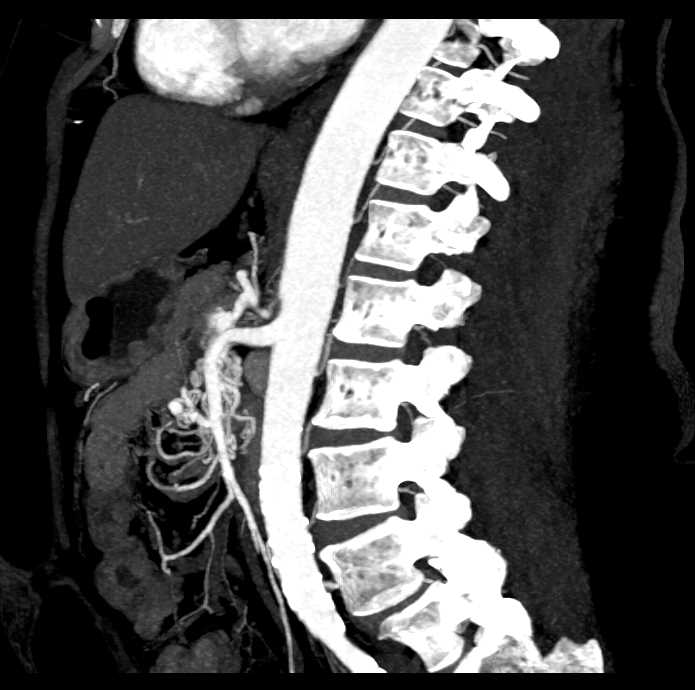 Intraductal Papillary Mucinous Neoplasm (IPMN) and Celiac Stenosis - CTisus CT Scan