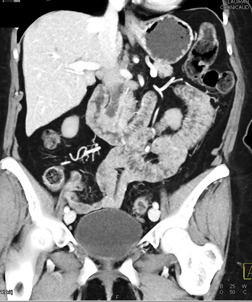 Ampullary Carcinoma - CTisus CT Scan