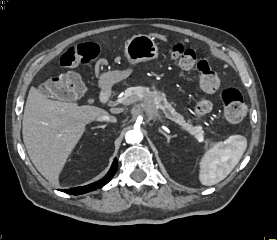 Pancreas Adenocarcinoma with Vessel Encasement - CTisus CT Scan