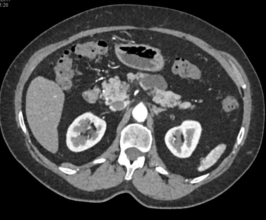 Intraductal Papillary Mucinous Neoplasm (IPMN) Body of the Pancreas - CTisus CT Scan