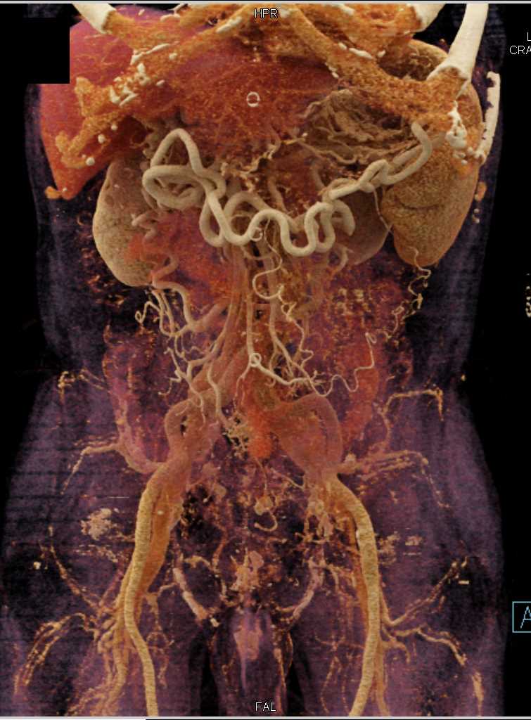 Pancreatic Cancer with Vascular Encasement - CTisus CT Scan