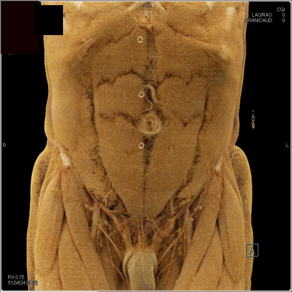 Pancreatic Cancer with Vascular Encasement - CTisus CT Scan