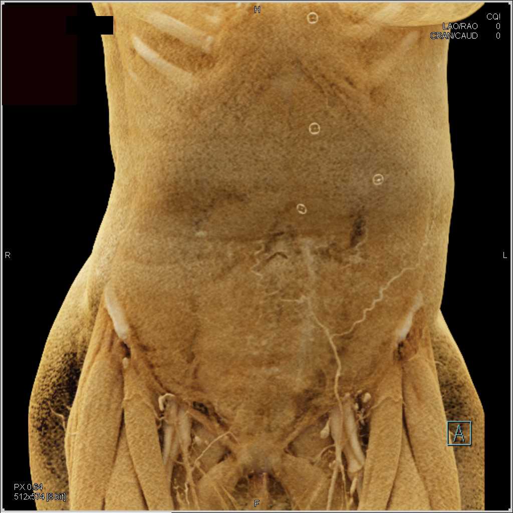 Pancreatic cancer with Encasement of the PV/SMV and Occlusion of the Splenic Vein - CTisus CT Scan