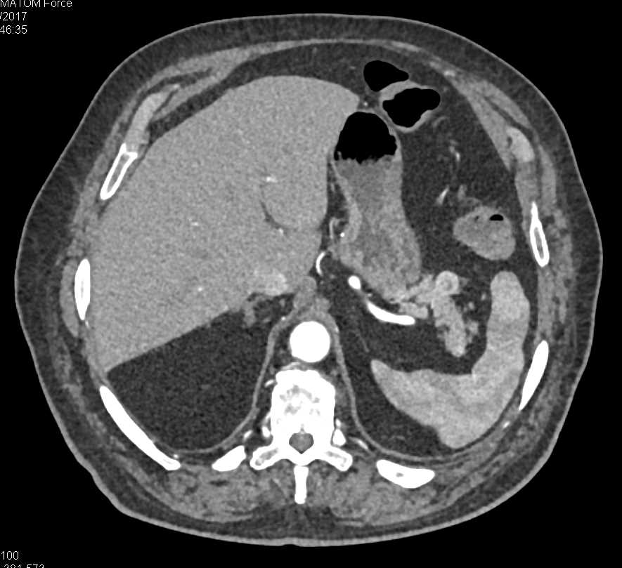 1cm Neuroendocrine Tumor of the Tail of the Pancreas - CTisus CT Scan