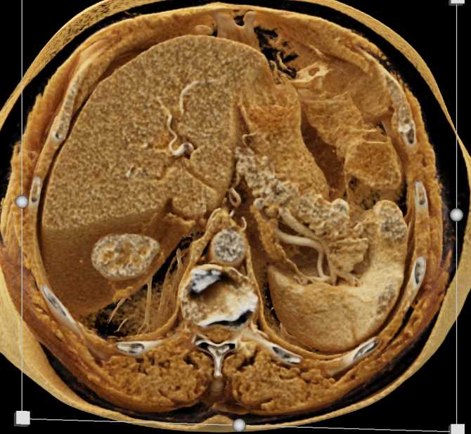 1cm Neuroendocrine Tumor of the Tail of the Pancreas with Cinematic Rendering - CTisus CT Scan