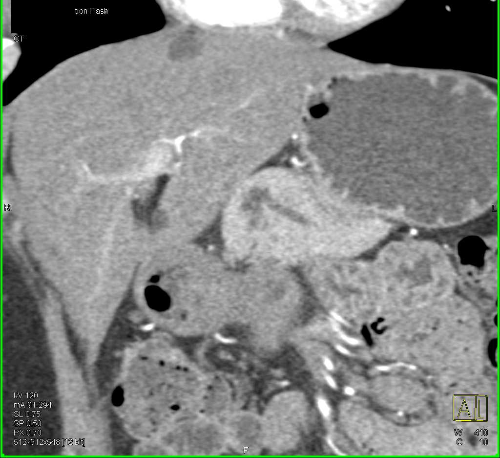 Main Duct Intraductal Papillary Mucinous Neoplasm (IPMN) - CTisus CT Scan