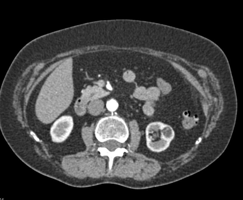 Pancreatic Neuroendocrine Tumor (PNET) Head of Pancreas - CTisus CT Scan