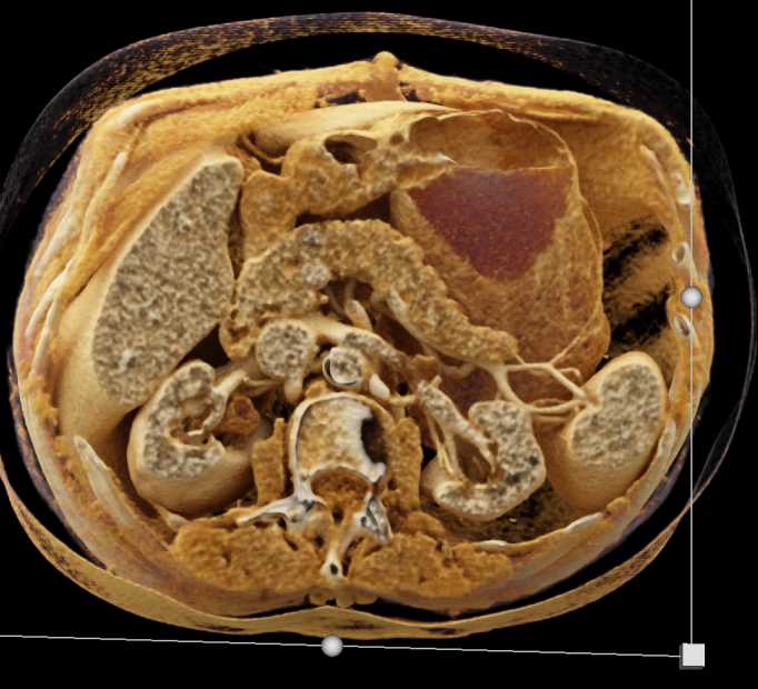 Pancreatic Neuroendocrine Tumor (PNET) Head of Pancreas - CTisus CT Scan