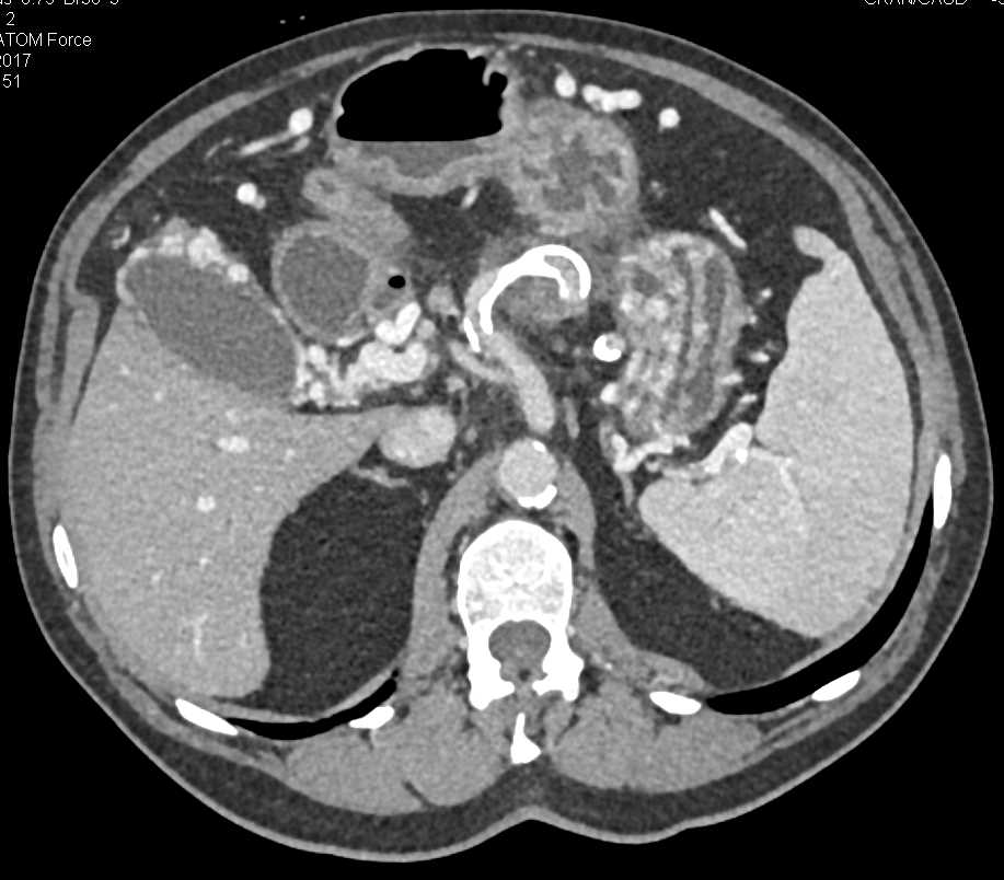 Carcinoma of the Pancreas with CTPV - CTisus CT Scan