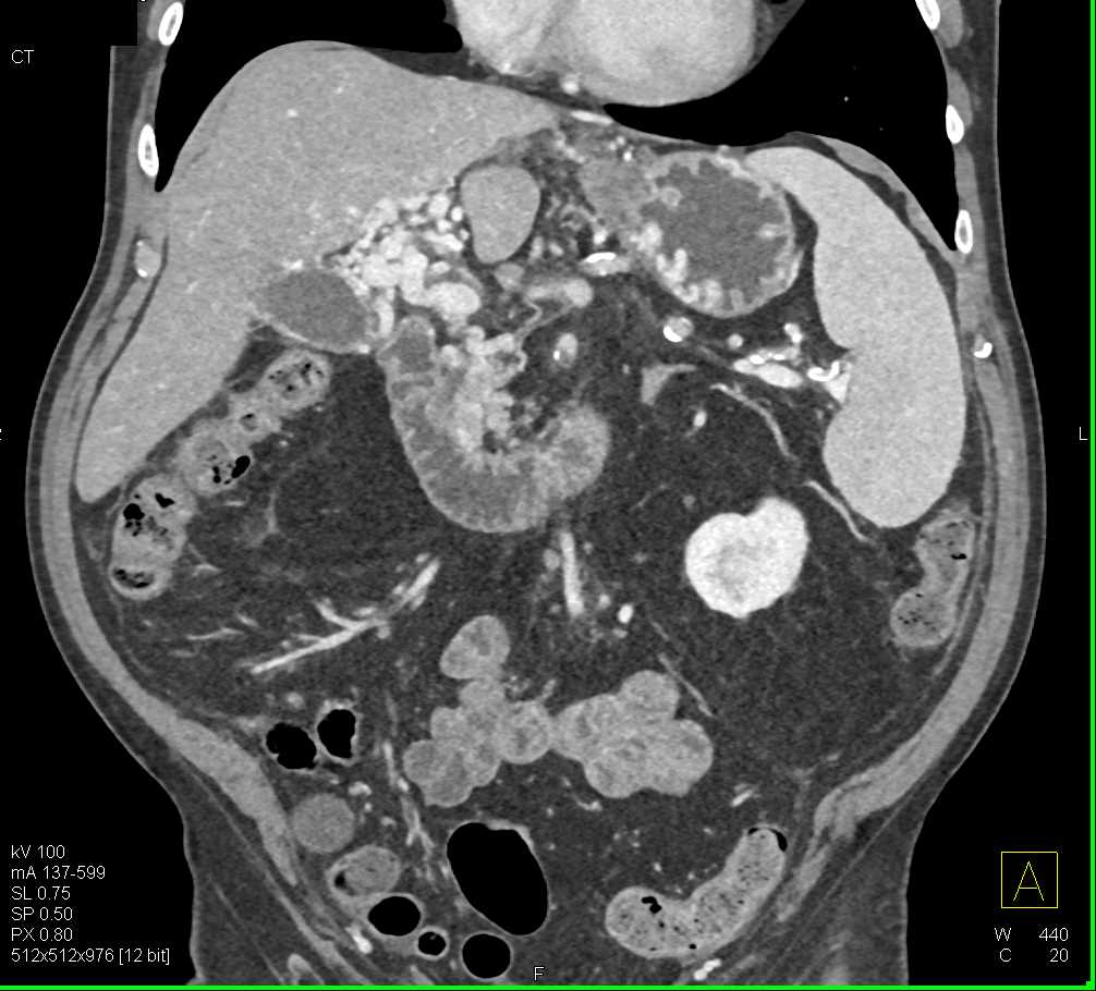 Carcinoma of the Pancreas with CTPV - CTisus CT Scan