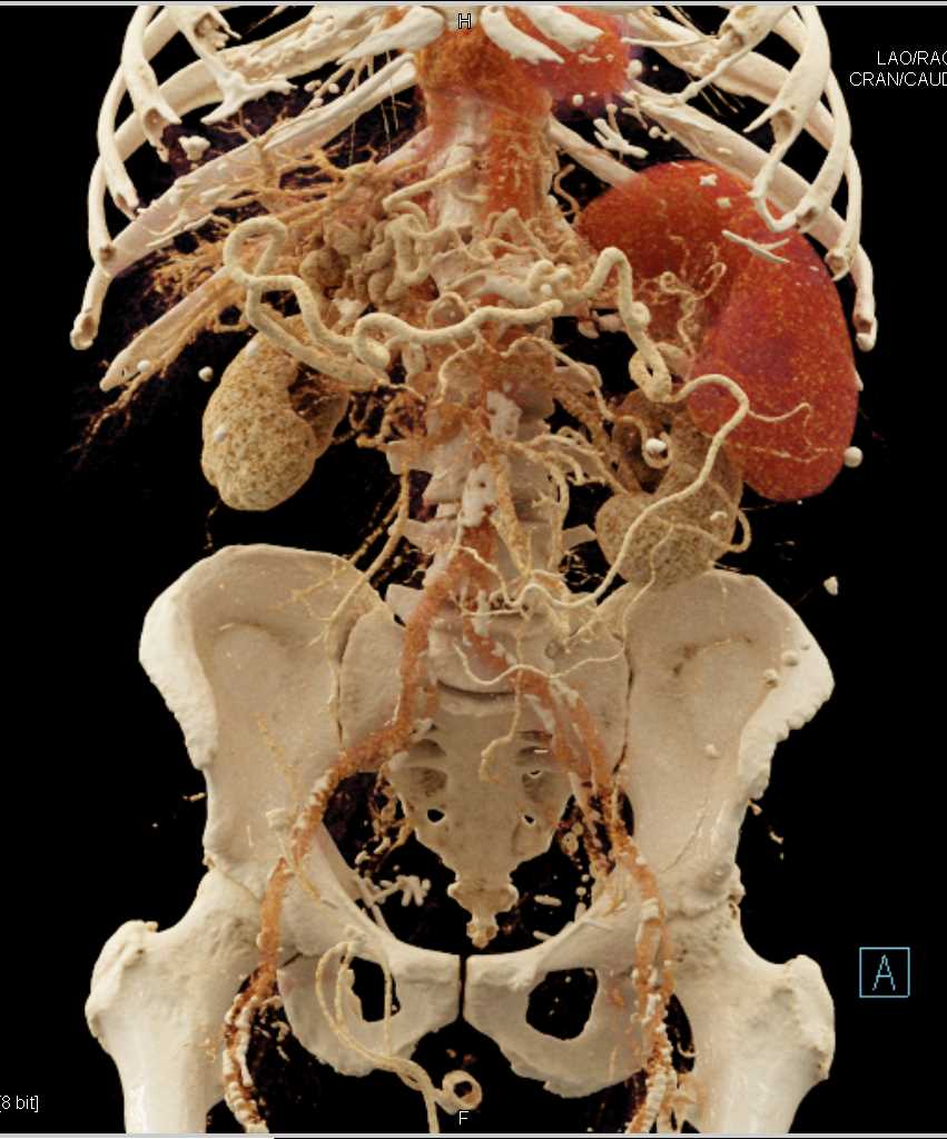 Cinematic Rendering of Pancreatic Adenocarcinoma with Multiple Collaterals - CTisus CT Scan