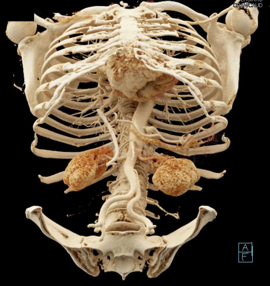 Pancreatic Adenocarcinoma with a Biliary Stent in Place and Cinematic Rendering - CTisus CT Scan