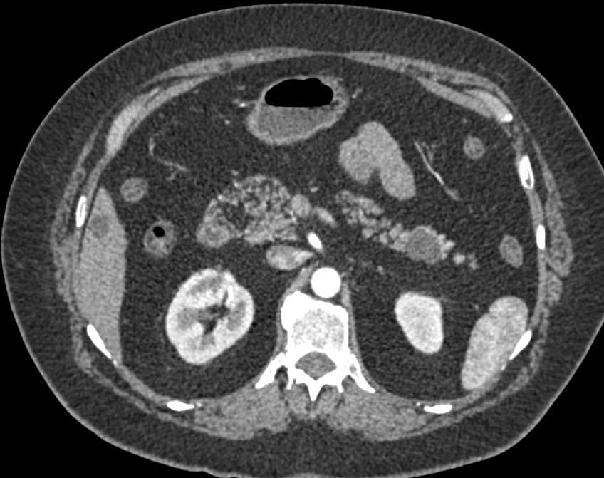 CTisus CT Scanning | IPMN Tail of the Pancreas