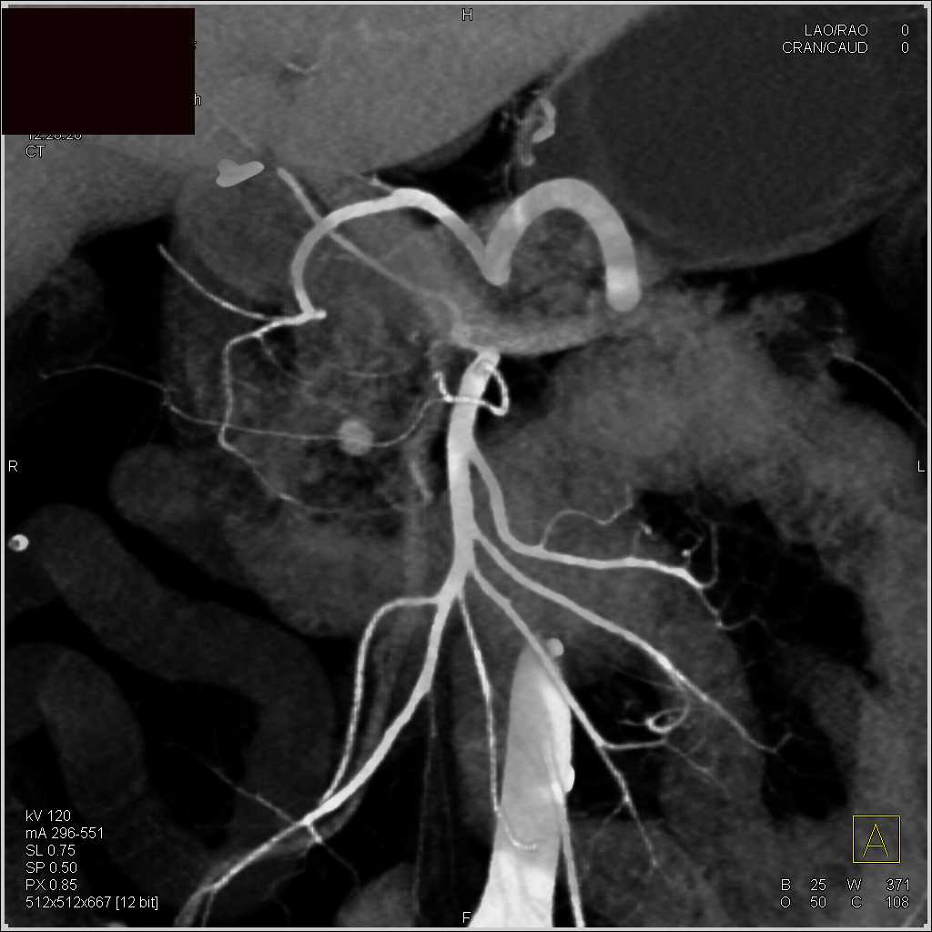 IPMN Tail of the Pancreas - CTisus CT Scan