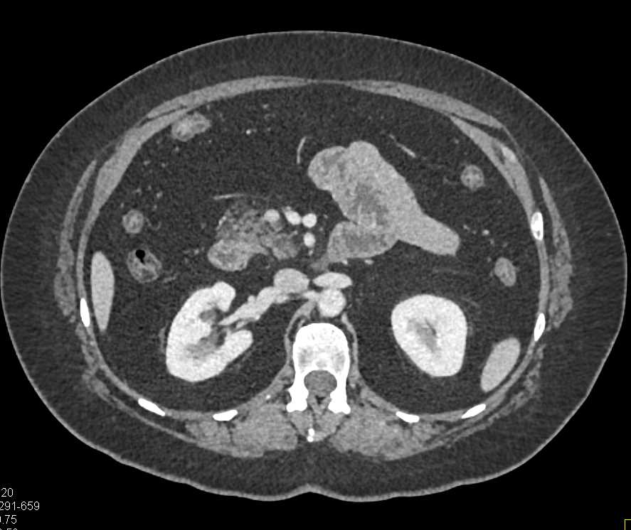 IPMN Tail of the Pancreas - CTisus CT Scan