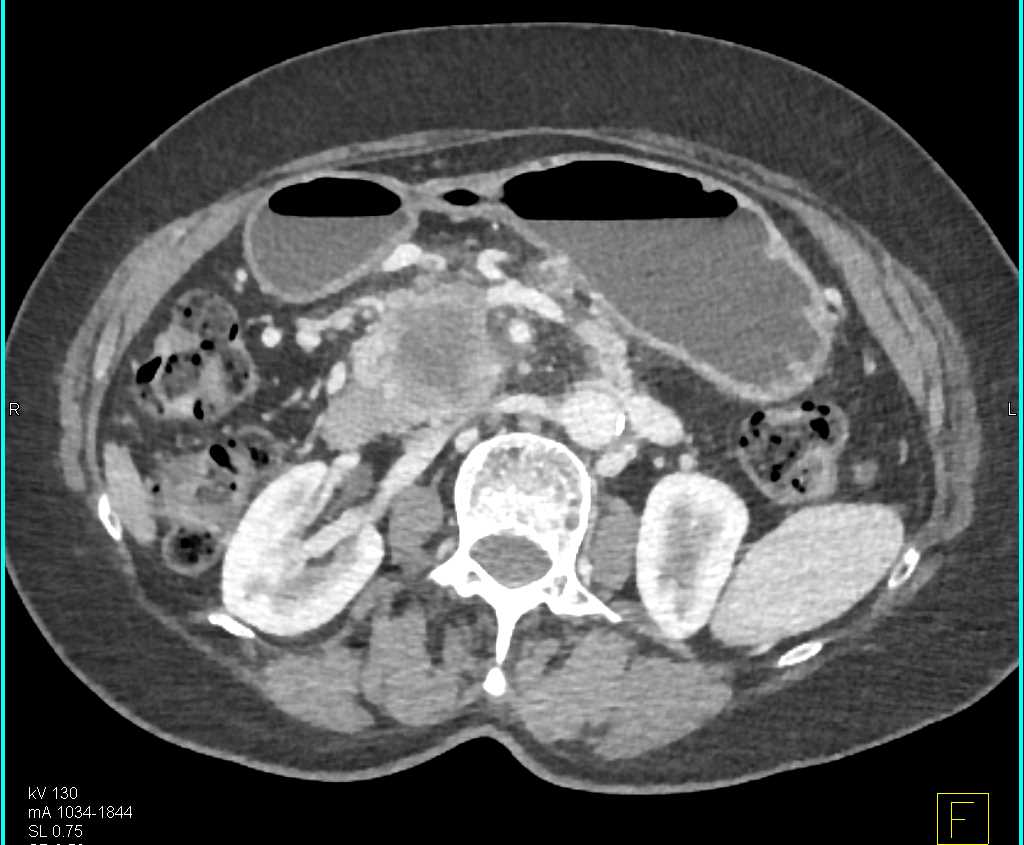 Pancreatic Cancer in the Head of the Pancreas - CTisus CT Scan