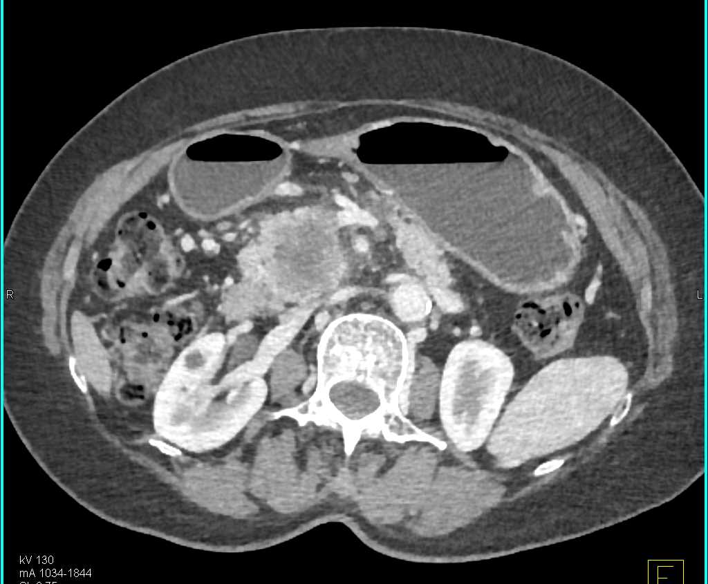 Pancreatic Cancer with Vascular Invasion - CTisus CT Scan