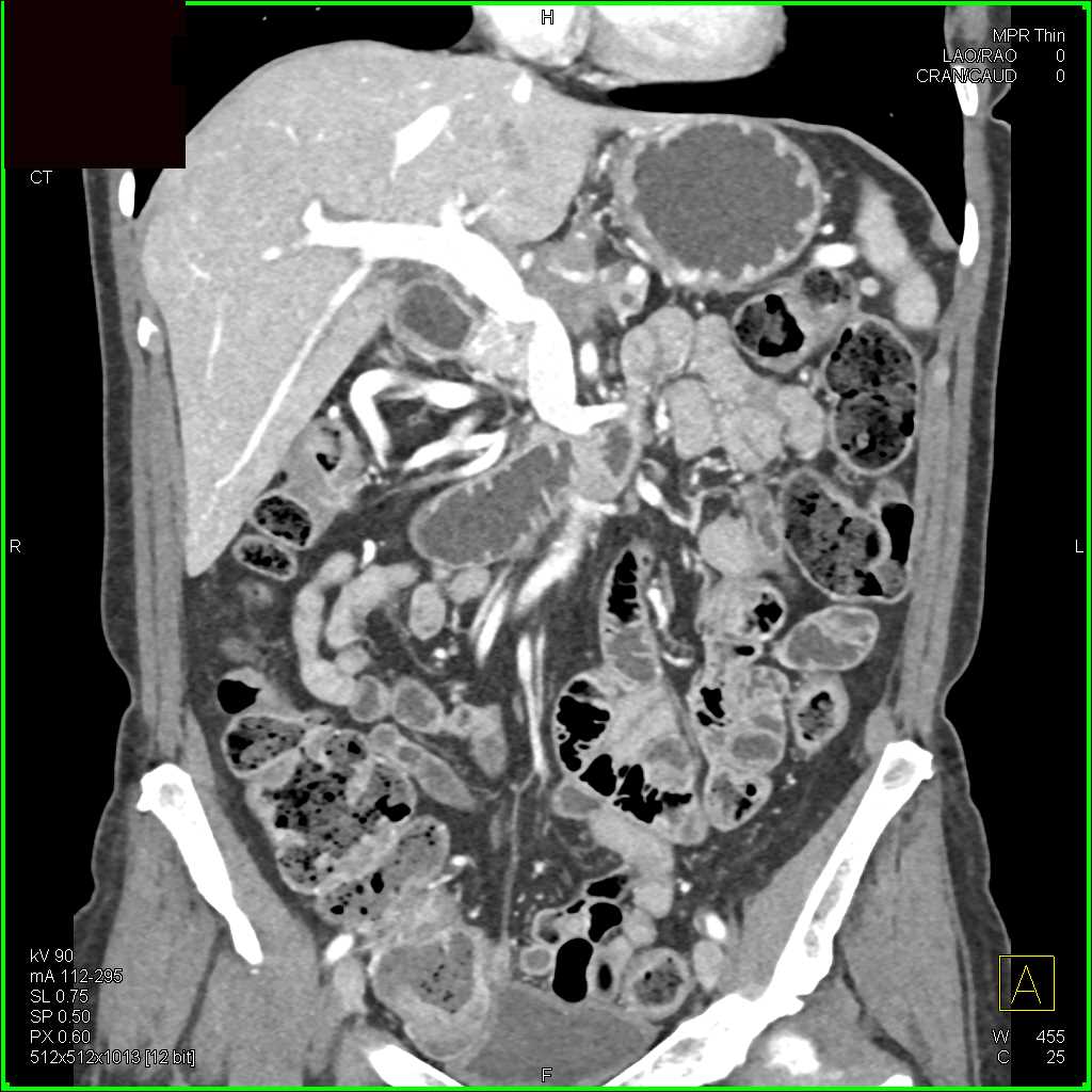 Pancreatic Adenocarcinoma with Vessel Encasement - CTisus CT Scan