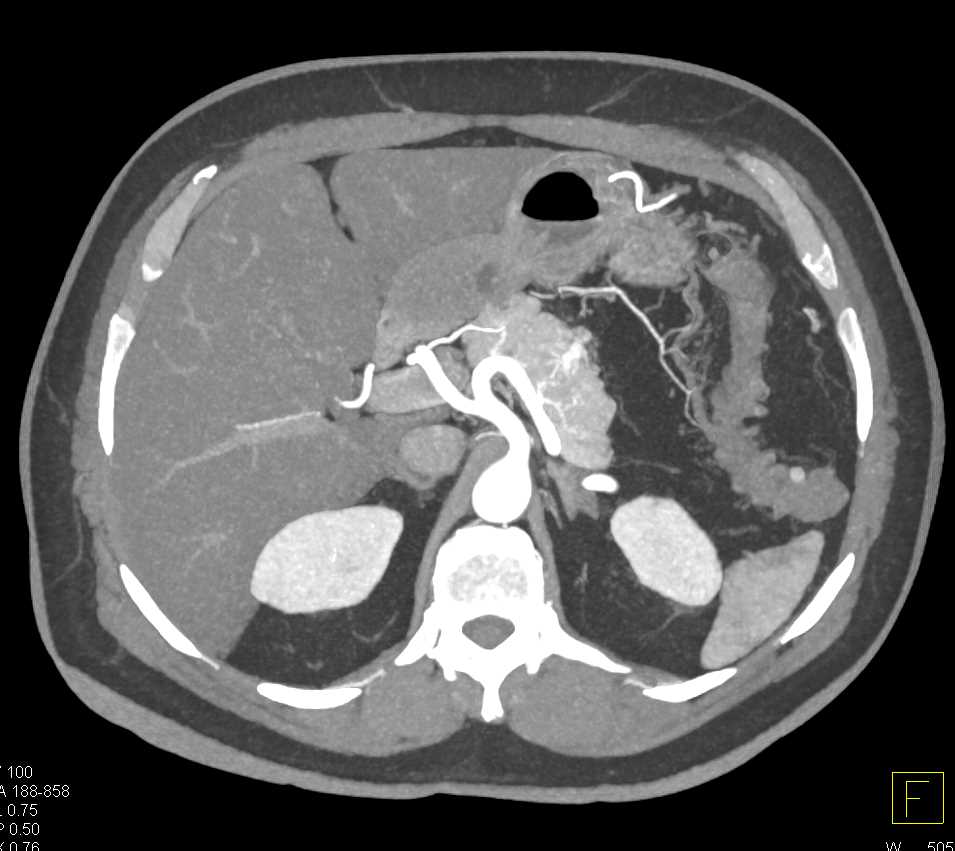 Multiple Pancreatic Neuroendocrine Tumors (PNETs) of the Pancreas - CTisus CT Scan